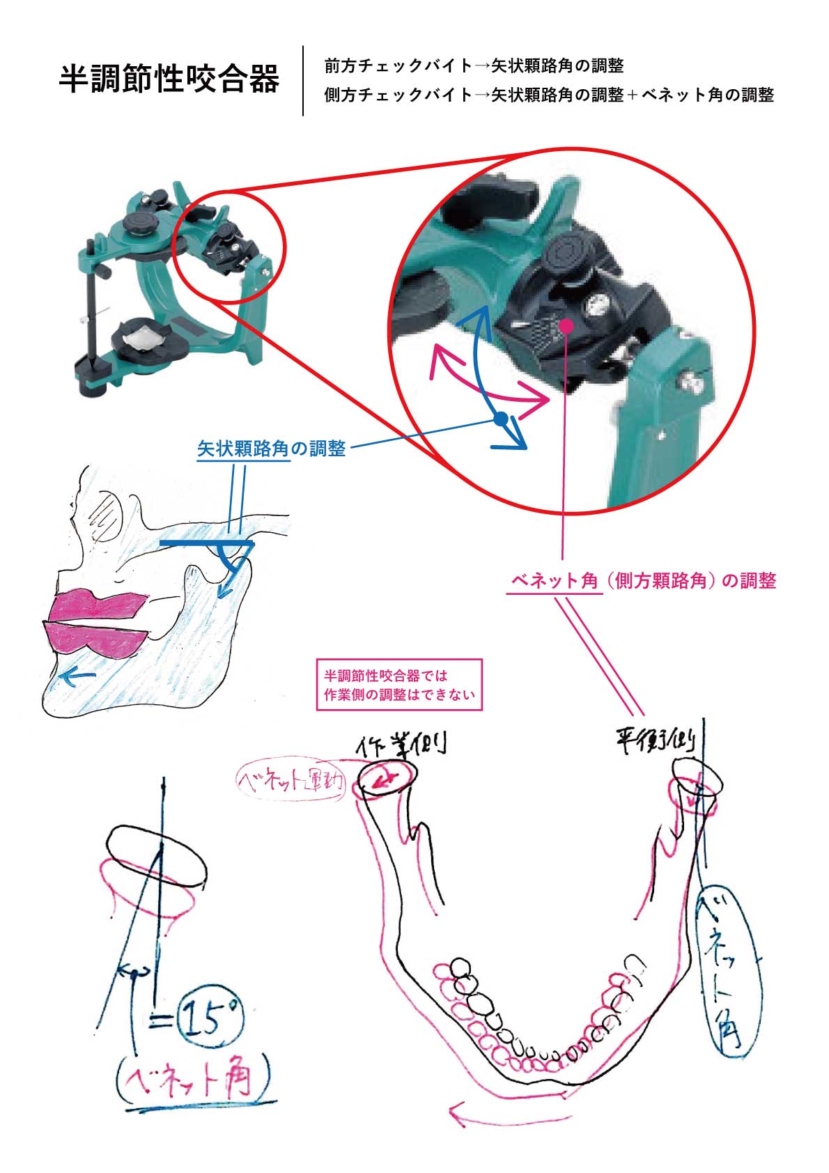 半調節性咬合器 - Denticola｜歯科医師国家試験のポイント