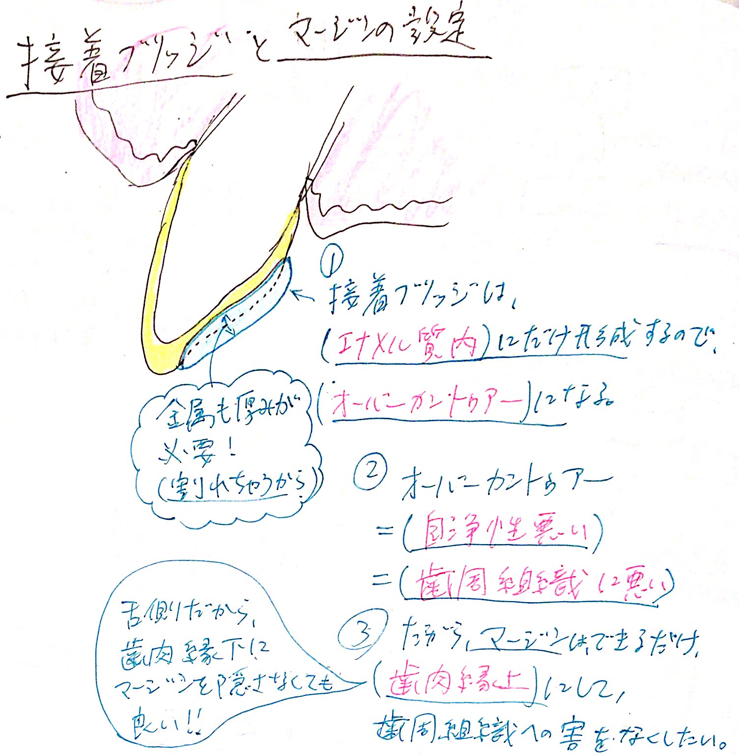 接着性ブリッジとマージン