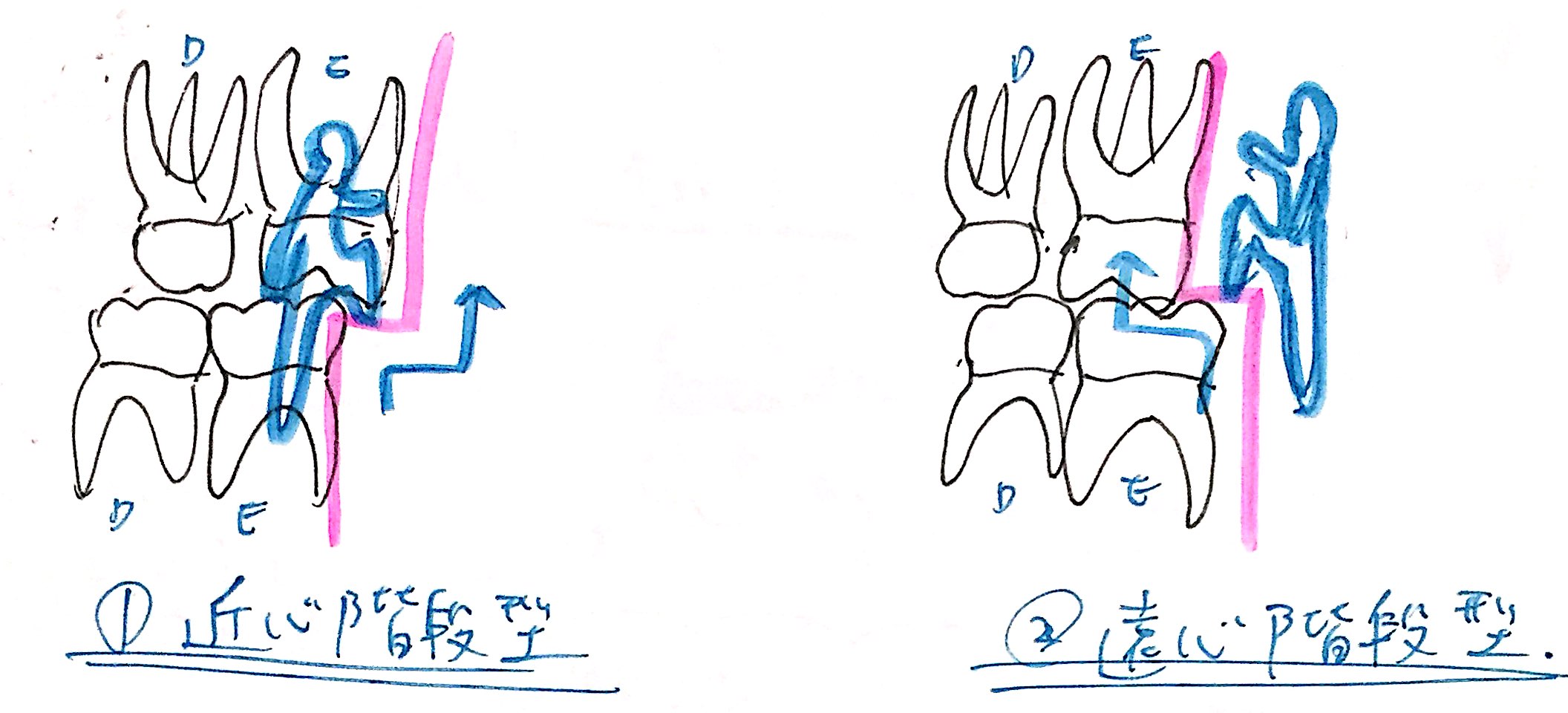 近親階段型、遠心階段型