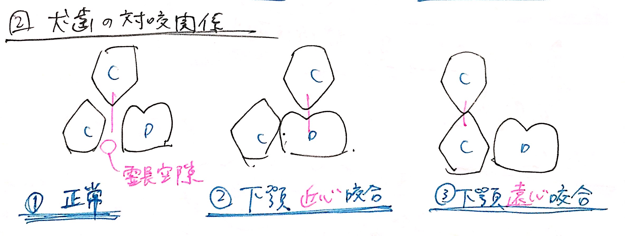 犬歯の対咬関係