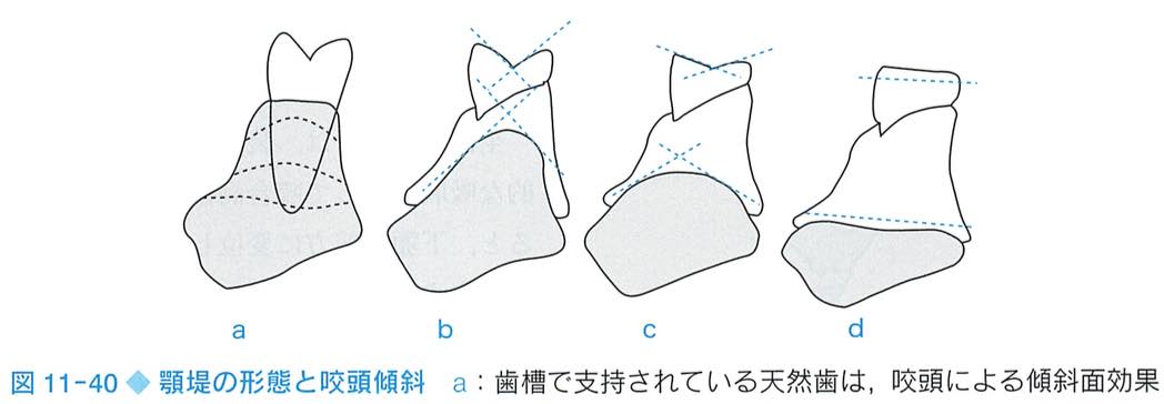 顎堤と咬頭傾斜角