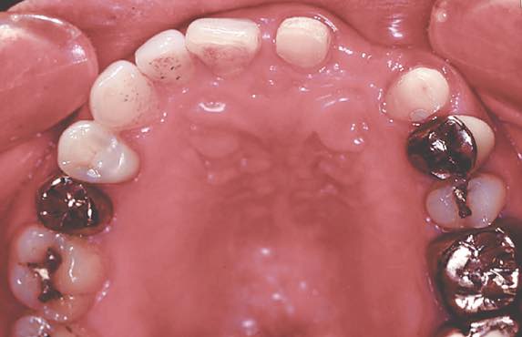 切歯路傾角」にも右と左がある！！ - Denticola｜歯科医師国家